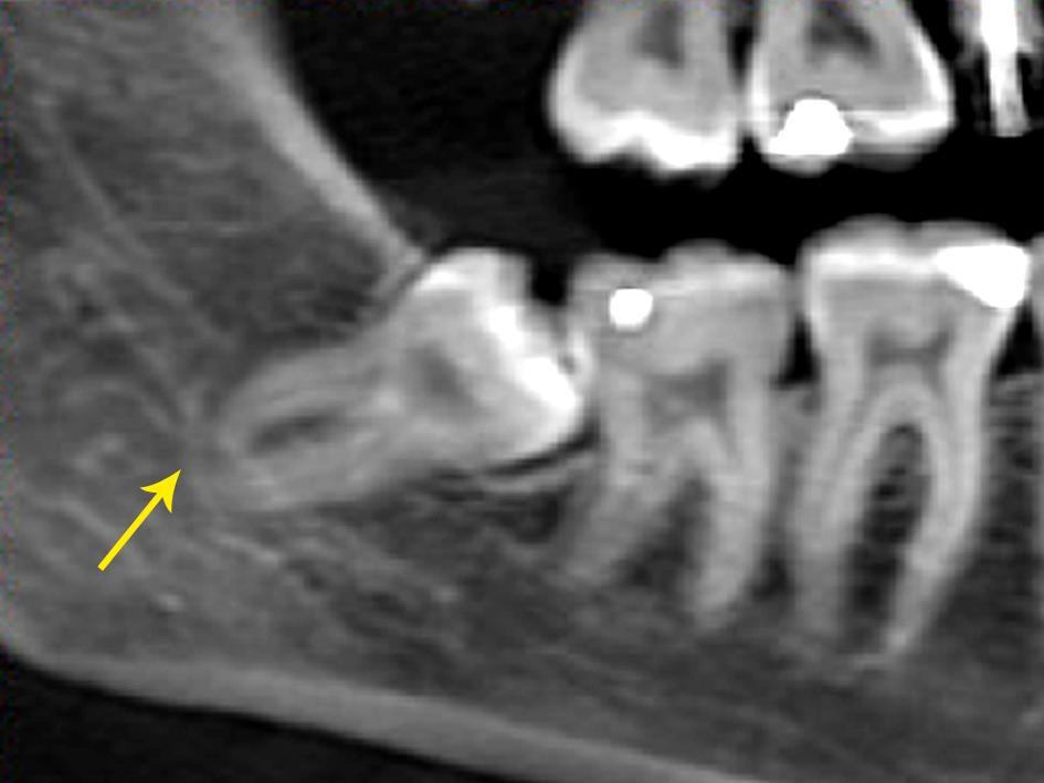 111 Após diagnóstico da íntima relação radicular dos 3M com o canal mandibular (CM), existem três possibilidades a considerar, como (1) não extrair o dente e realizar tratamento de segunda indicação,