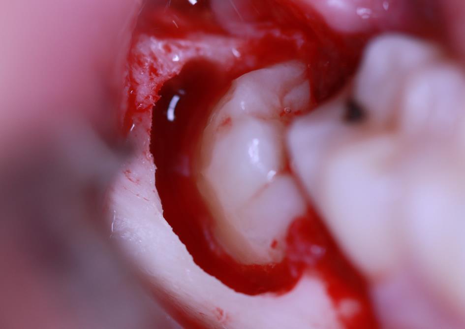 Em ambulatório, foi realizada anestesia dos nervos alveolar inferior, bucal e lingual, incisão de Winter, descolamento mucoperiosteal, ostectomia (Fig. 3), odontossecção (Fig.