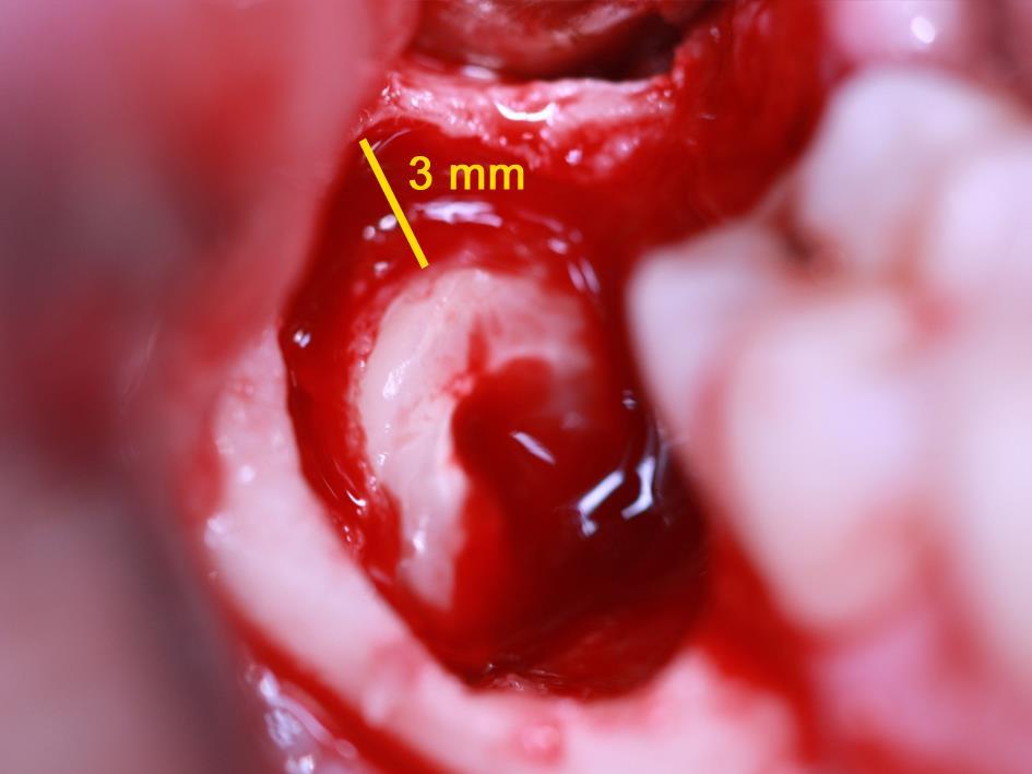 5 Após a clivagem e remoção da coroa com extrator reto tipo Seldin nº 1 foi realizado desgaste do remanescente dentário, com broca Zecrya (nº 151 - Tungstênio - Komet ), até 3 mm abaixo do nível da
