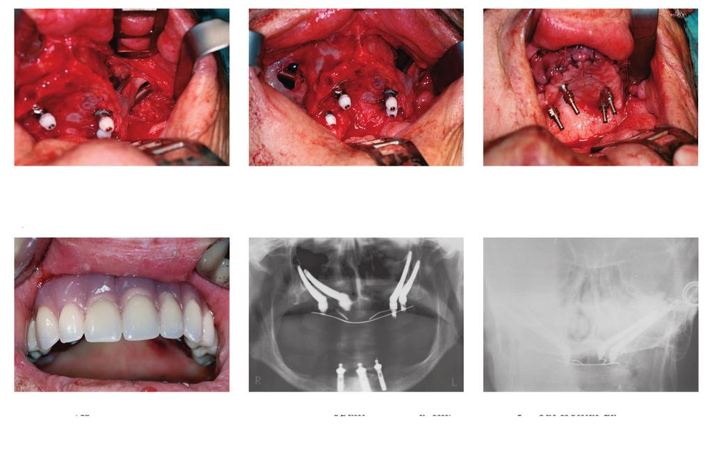 Fig. 10 Vista maxilar dos 2 implantes zygoma colocados no 2º Quadrante Fig. 11 Vista maxilar dos 4 implantes zygoma Fig. 12 Impressões intra-operatórias Fig.