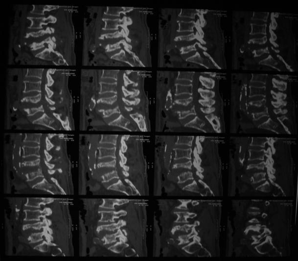 Figura 2 - CT demonstrando acometimento de L4 e L5 (setas brancas). (Imagens cedidas arquivo Dr.