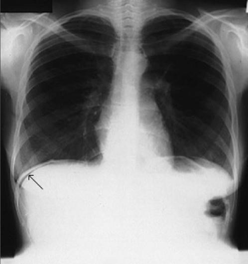 SEMIOLOGIA RADIOLÓGICA DO ABDOME Radiografia de tórax ortostático: - Afastar causas