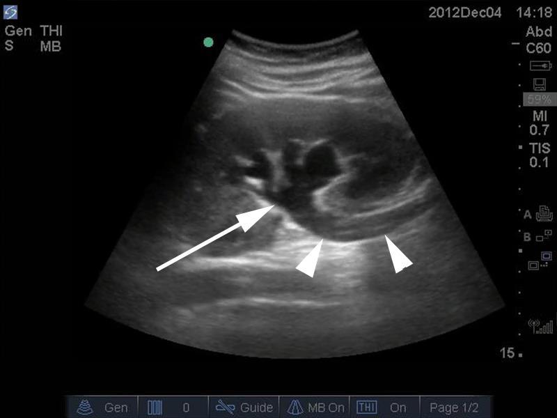 uropatia obstrutiva Menor sensibilidade para detecção de cálculos não obstrutivos < 5 mm (cálculos > 5mm sensibilidade de 96% e