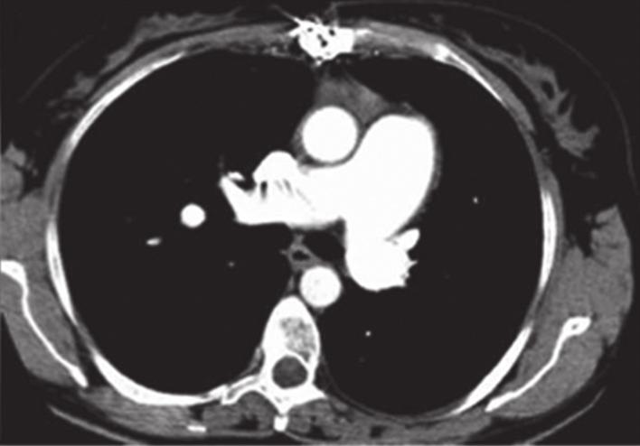 Em c), ressonância magnética cardíaca de um paciente com hipertensão pulmonar. Imagem sem contraste do eixo curto com o ventrículo direito à esquerda e o ventrículo esquerdo à direita da figura.