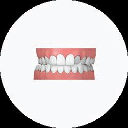 Casos tratáveis Dentes apinhados Isso ocorre quando falta espaço no arco dentário para que todos os dentes se encaixem.