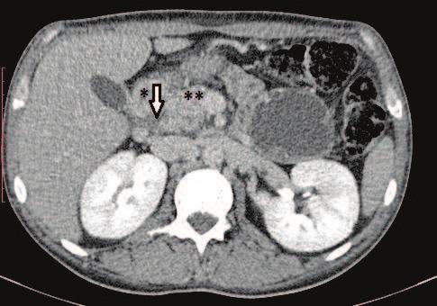 pancreatite de sulco é uma doença rara e os pacientes acometidos são geralmente homens com 40-50 anos, com relacionados à pancreatite crônica como episódios de dor abdominal, náuseas e perda ponderal.