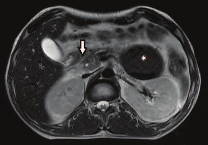 Há ainda imagem cística bem delimitada com pancreáticos, correspondendo à necrose pancreática delimitada