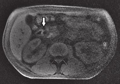Necrose pancreática delimitada como achado Figura 4. Imagens axiais de RM ponderadas em T1 (a) e T2 (b).