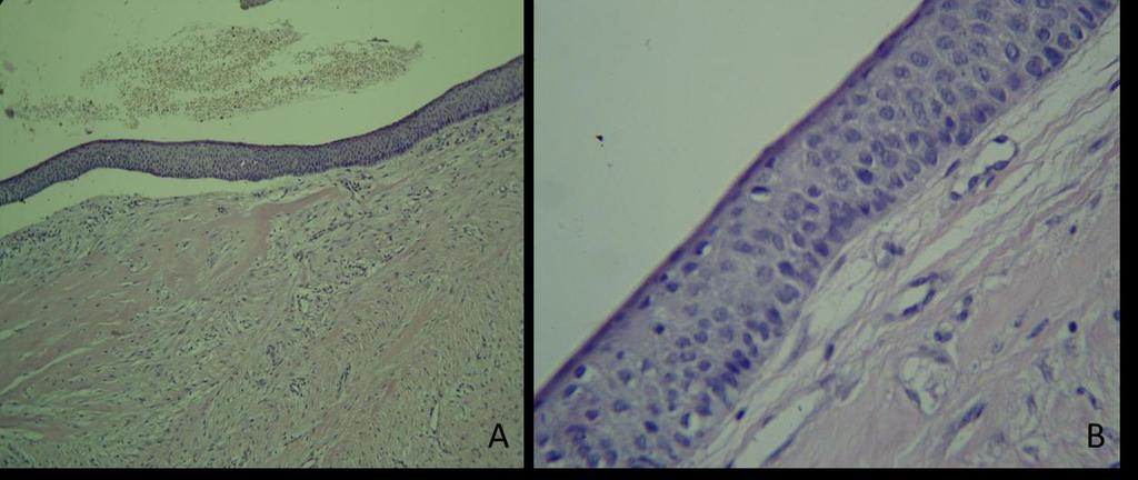 estratificado que exibe camada basal de células colunares baixas, dispostas em paliçada com núcleos hipercromáticos, além de camada superficial de paraceratina corrugada e cápsula de tecido
