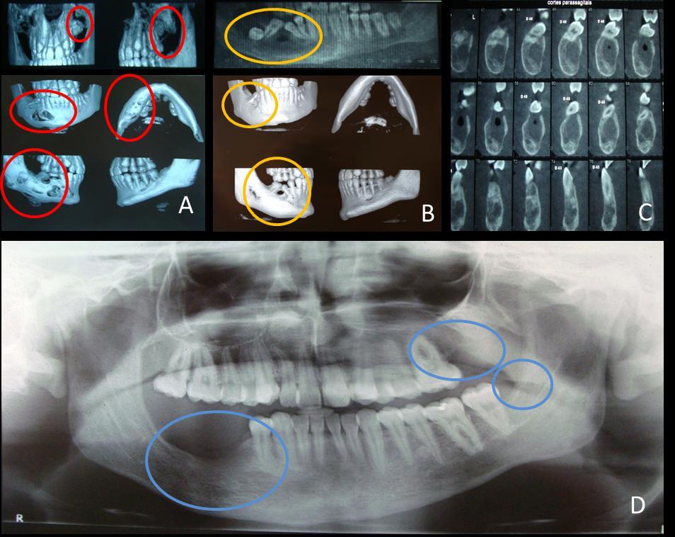 12 Figura 4. Evolução do paciente durante o tratamento. A Imagem de tomografia computadorizada no inicio do tratamento.
