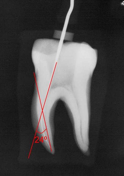 presa em um suporte de madeira com dimensões de 15x15cm e 2 cm de espessura. A instrumentação de todos os dentes desta pesquisa foi realizada por um único operador.