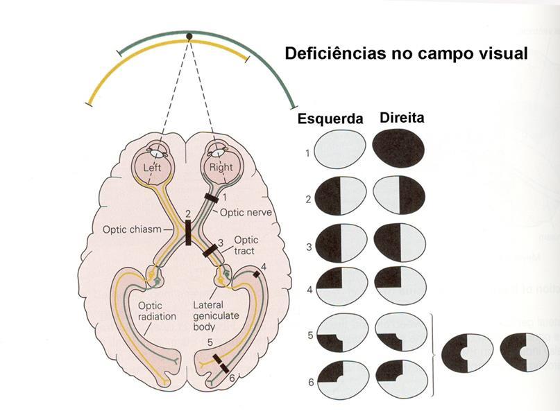 Organização da percepção visual Lesão de Vis.