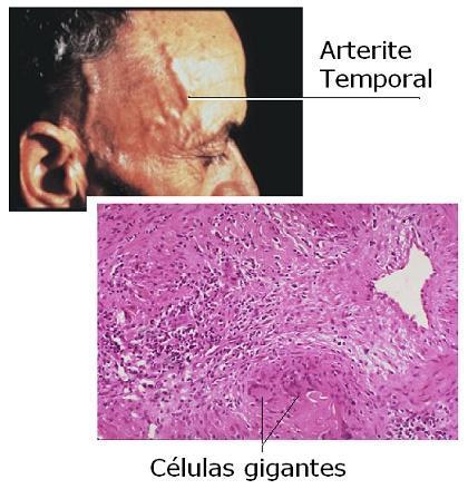 ARTERITE TEMPORAL Arterite de células gigantes - artéria temporal superficial Ocorre acima