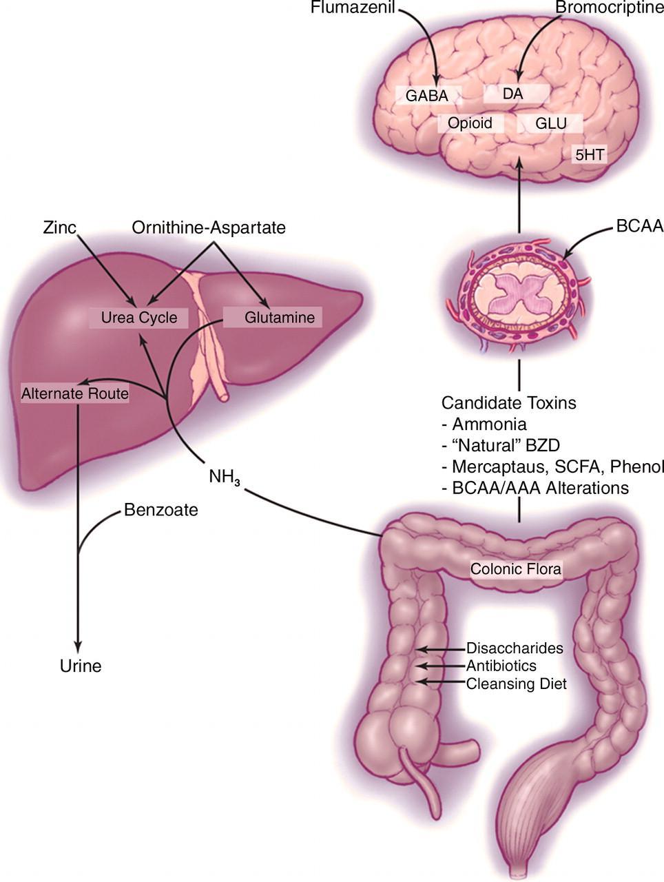 DOENÇA HEPÁTICA ENCEFALOPATIA HEPÁTICA Amônia Insuficiência hepática crônica Sangue portal desvia para a