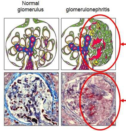 Glomerulonefrite Crônica Causa: Glomerulonefrite aguda não curada num período de 1 a 2 anos, apresentando lesão progressiva do tecido renal.