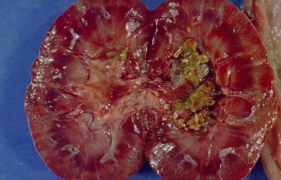 Insuficiência Renal Aguda - IRA Causas: Pós-renais: Obstrução do trato urinário por cálculo, tumores, hipertrofia prostática e estenoses.