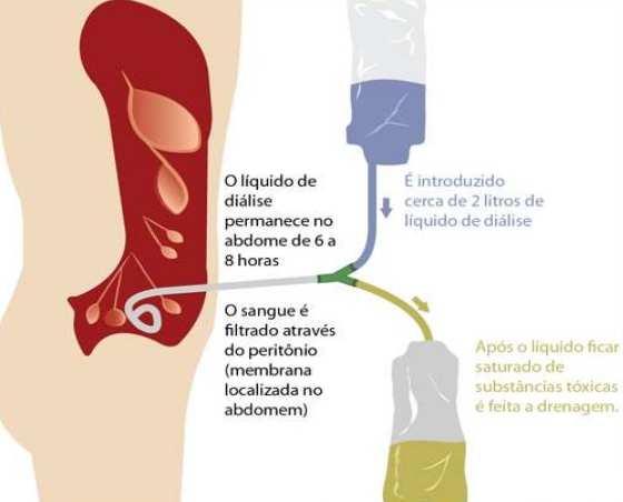 trocáter, material para anestesia local, anti-sépticos, frascos de solução dializadora, equipo especial em Y, campo fenestrado,