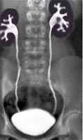 Urografia Excretora (Pielografia EV ou urografia intravenosa) Tiram-se radiografias
