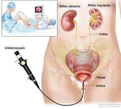 Urolitíase Tratamento e cuidados de enfermagem: Ureterolitotripsia Urolitíase