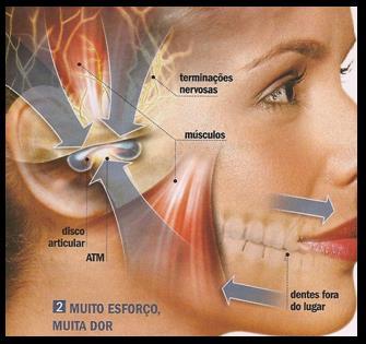 Ossos A ATM envolve de cada lado da cabeça, dois ossos: o temporal e a cabeça da mandíbula, parte do processo condilar da mandíbula. Ambas as superfícies ósseas são recobertas por fibrocartilagem.