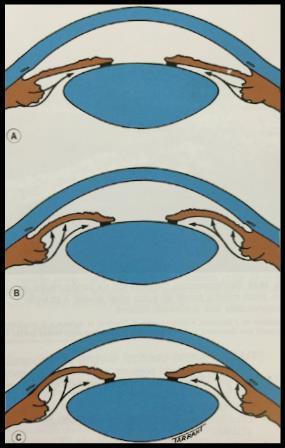 indivíduos cegos por glaucoma de ângulo fechado.