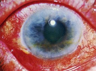 Figura 1 - Hiperemia conjuntival, embaçamento corneal e pupila moderadamente dilatada. Fonte: Uptodate.com TESTES DIAGNÓSTICOS Tonometria: é a mensuração da pressão intra-ocular.