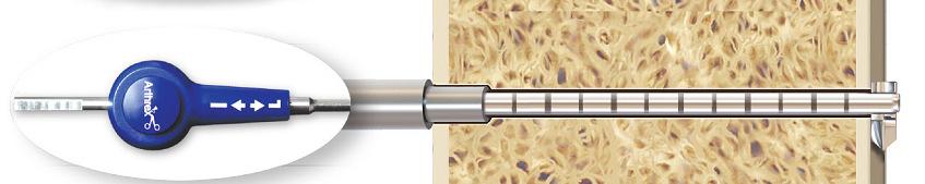 peróla cirúrgica: Para controlar a longitude intraóssea, coloque a agulha do FlipCutter II na camisa de broca e introduza contra o osso.