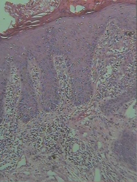 49 Figura 08: Queilite actínica: displasia moderada, projeções epiteliais em gota, degeneração hidrópitica, espongiose, paraqueratose