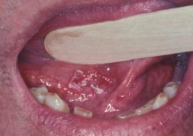 Exame Intra-oral Leucoeritroplasia Nesbit, Samuel P.