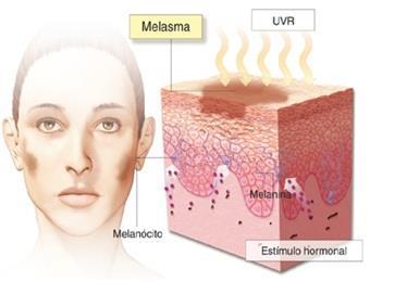 MELASMAS Hormônio célula de