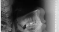 Obedecendo-se à distância de 1,52 m da fonte de raios-x ao objeto, utilizou-se um filtro de alumínio de para se evidenciar o perfil tegumentar da face.