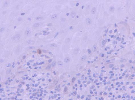proteína caspase 3 clivada, no grupo dos carcinomas