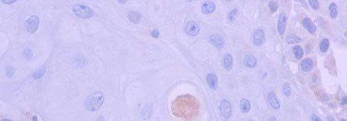 c-cas-3 nos carcinomas Lesão/localização