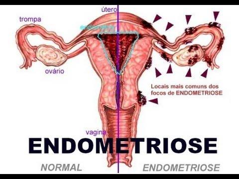 Endometriose Desenvolvimento e crescimento de glândulas endometriais fora da cavidade uterina, o que resulta numa reação inflamatória crônica.