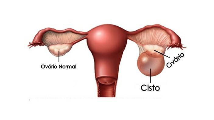 CISTO DE OVÁRIO O cisto é um tumor com conteúdo líquido, que se forma dentro ou ao redor do ovário, que pode provocar: dor na região pélvica, atraso na menstruação ou dificuldade para engravidar.