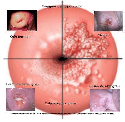 CÂNCER DE COLO UTERINO É uma doença que evolui silenciosamente e caracteriza-se pela alteração das células do colo uterino.