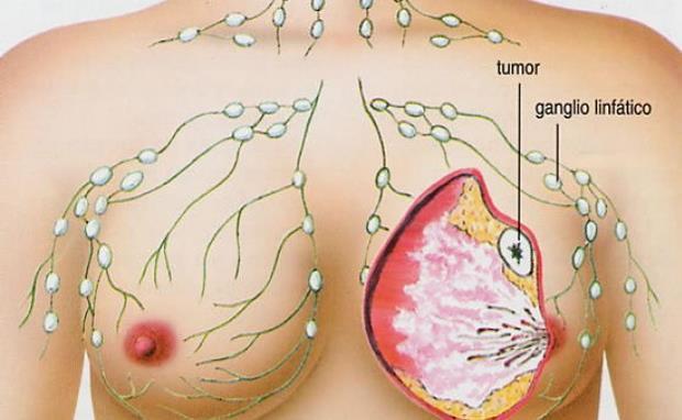 CÂNCER DE MAMA A mama é uma glândula influenciada por hormônios. Sofre variações no tamanho, forma e função dependendo de fatores como o ciclo menstrual e gravidez.