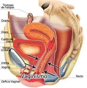 Sintomas: Corrimento vaginal, acompanhado ou não de prurido.