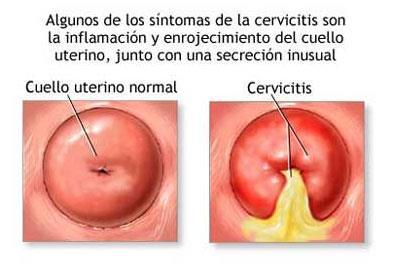 CERVICITES São inflamações localizadas no colo do útero, podendo ser agudas ou crônicas.