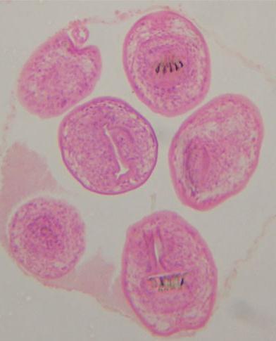 hidático Características: composta por protoescólices,