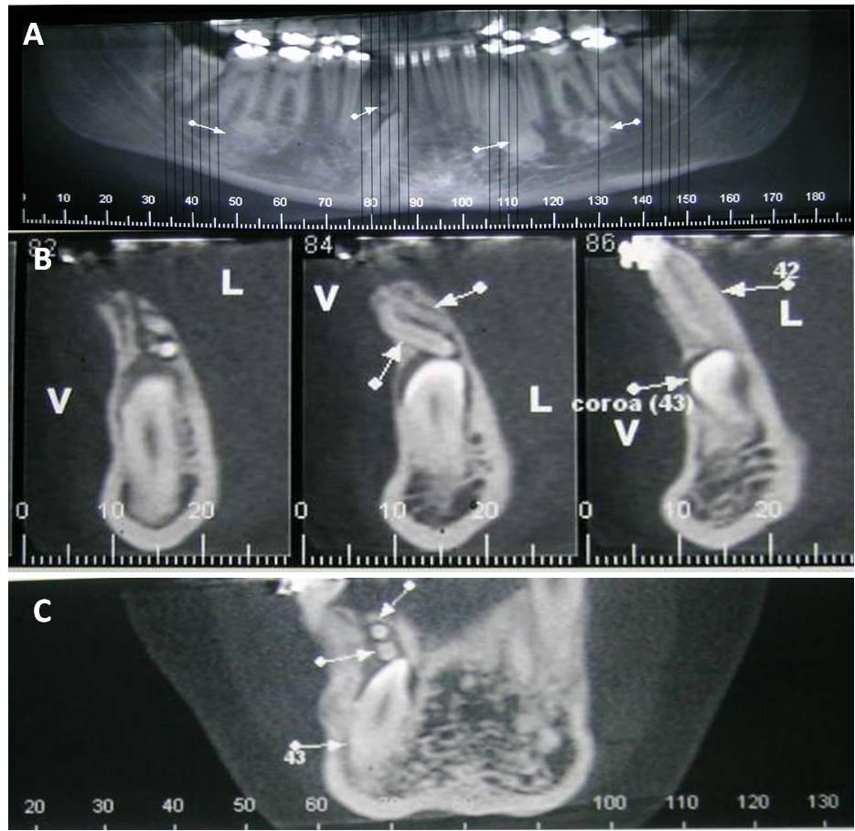 imaginológicos compatíveis com odontoma composto, foi realizada intervenção cirúrgica no bloco cirúrgico da referida instituição para a remoção do tumor e adaptação de dispositivo de tracionamento no