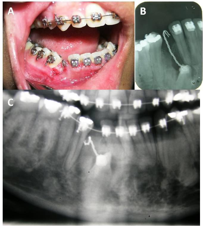 SANTOS, et al. Figura 3 Aspecto clínico e radiográfico pós-operatório de sete dias (A e B) e durante as consultas de proservação (C).