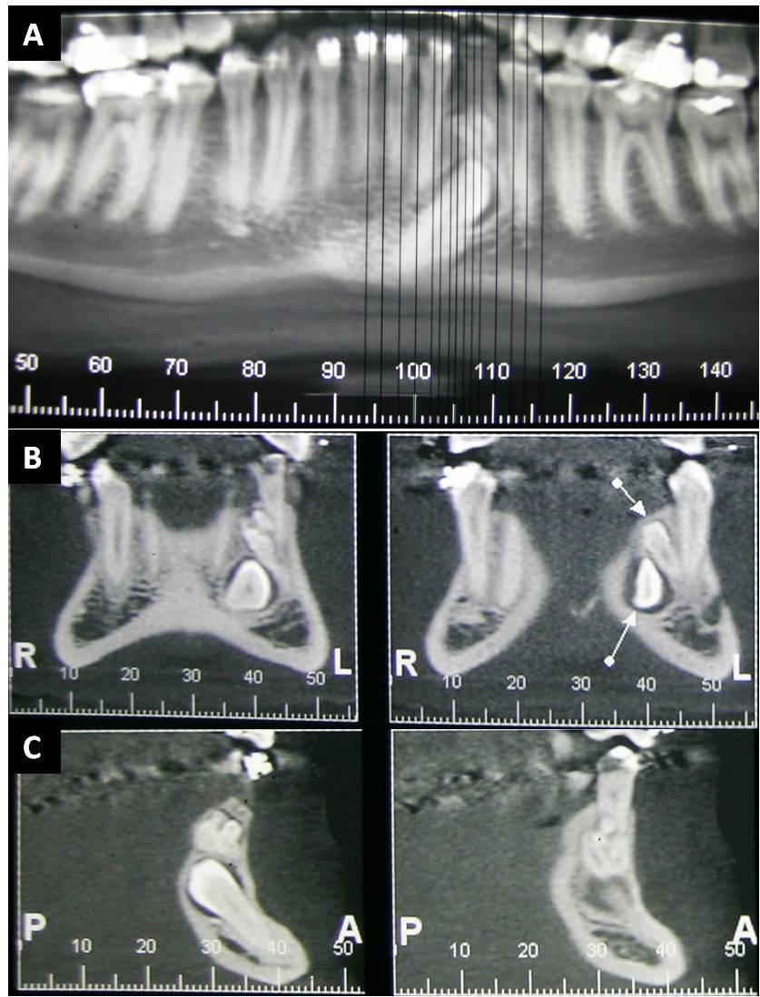 Imagem panorâmica (A), cortes coronais (B) e sagitais (C). inferior esquerdo permanente (elemento 33).