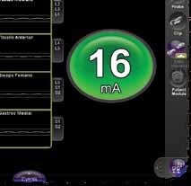 Utilizando a direcionalidade discreta em tempo real e a informação de proximidade relativa do nervo, o NVJJB/ M5