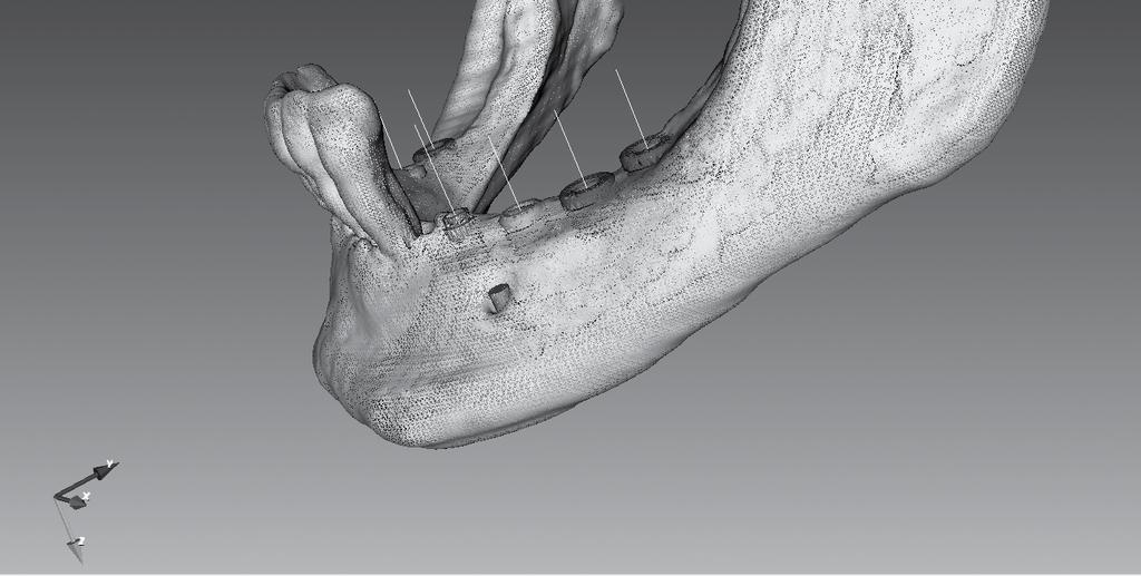 QUE VANTAGENS OFERECE? SEGURANÇA E ÊXITO NA OPERAÇÃO O BTI Scan 3 permite determinar a densidade óssea de cada ponto do osso alveolar, dentro e fora dos implantes a colocar.