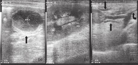 Na radiografia abdominal confirmou-se a microhepatia e a renomegalia.