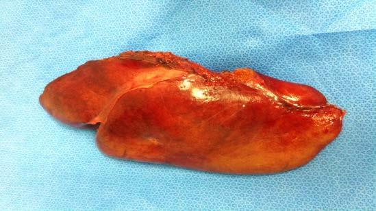 Surgery Left Hepatectomy with 3 wedges and 1 RFA + Left