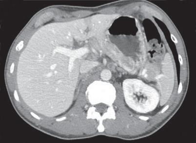 Todos pacts submetidos a QT pré-op (cirurgia apenas se estabilização ou resposta) Sobrevida 5 anos 25%