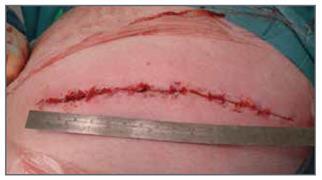 8 Em um estudo randomizado de 67 pacientes, a tecnologia adesiva do Liquiband foi utilizado, bem como a sutura padrão no fechamento de incisões na pele columelar, utilizados para rinoplastia externa,