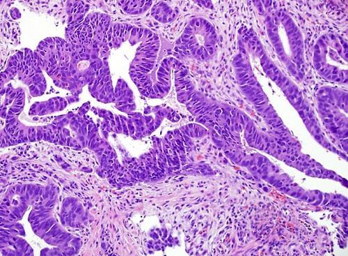 DIAGNÓSTICO ANÁTOMO-PATOLÓGICO Histologia: adenocarcinoma 95% (linfoma,